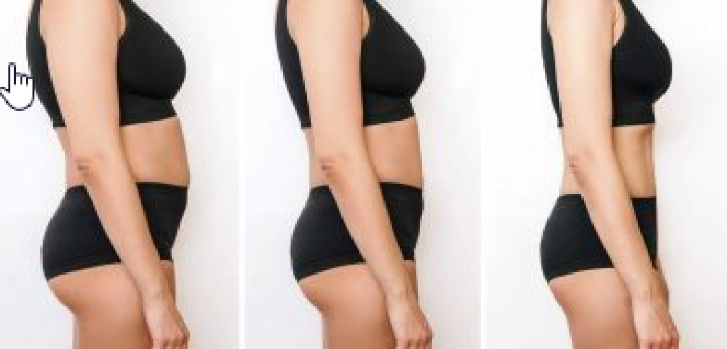 Medical Weight Loss, non-surgical weight loss program