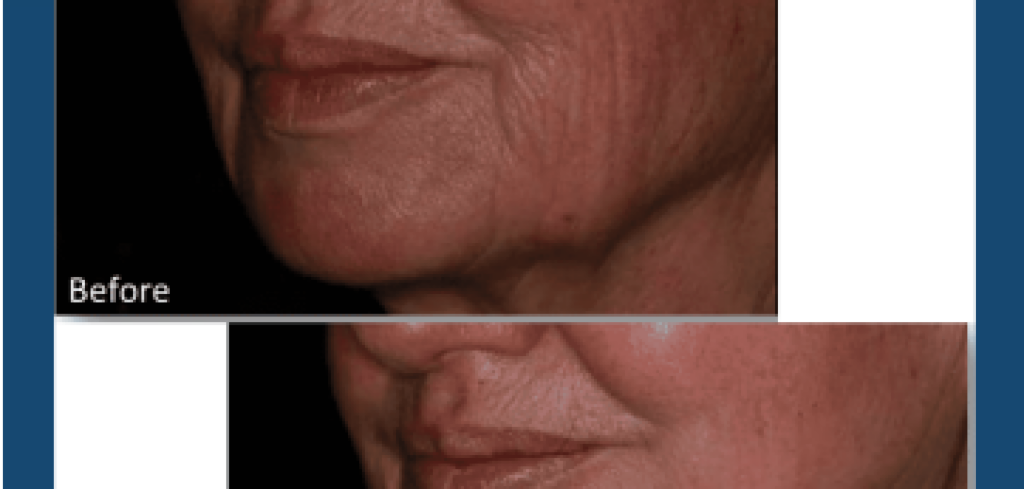 RF Microneedling makes your winkles disappear, long lasting