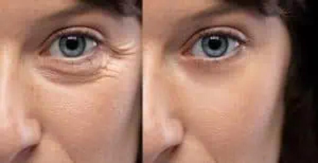 Botox injections to minimize wrinkles, forehead, crows feets